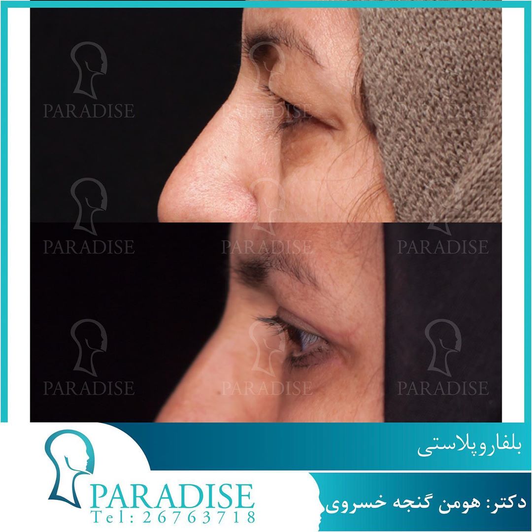 بلفاروپلاستی دکتر هومن گنجه خسروی