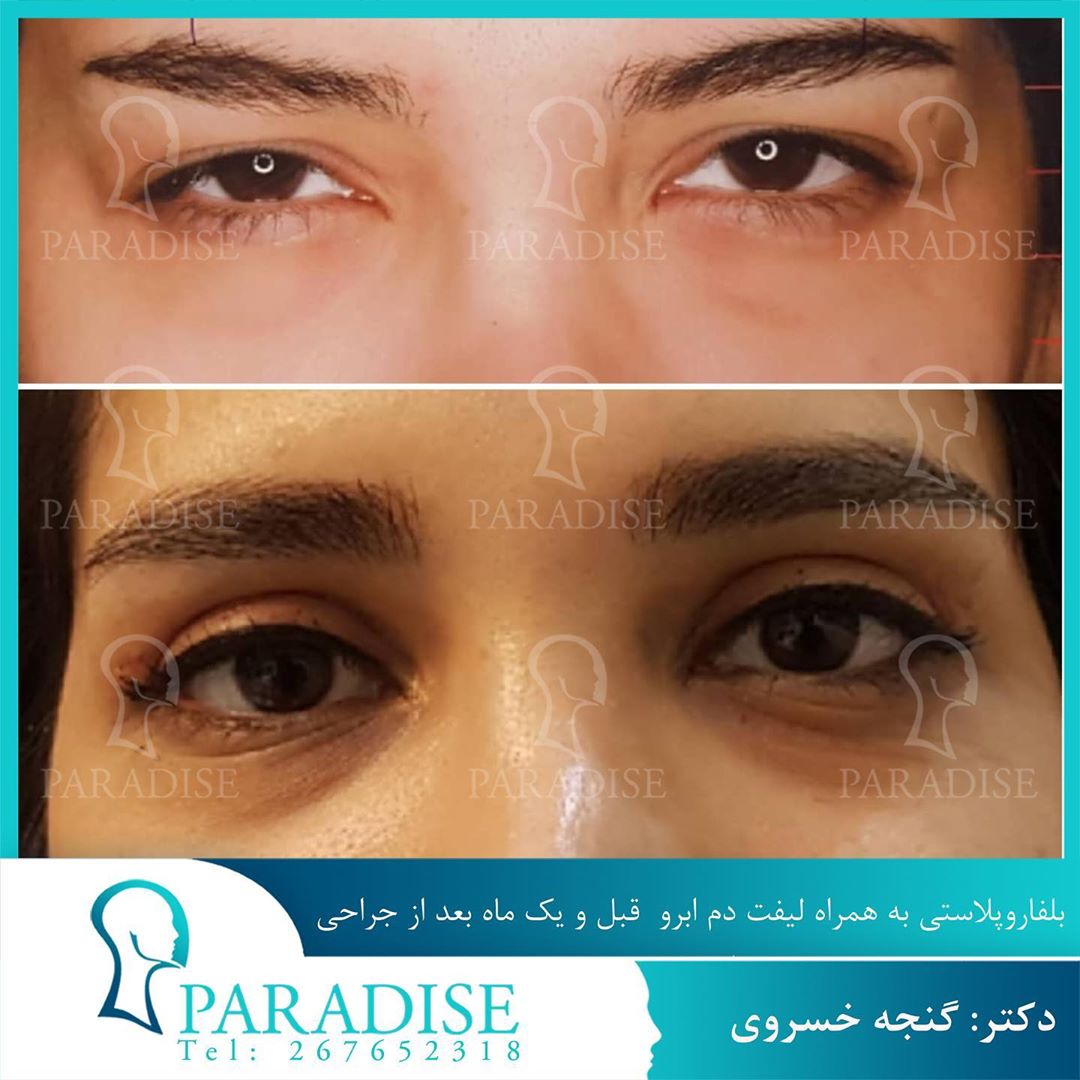 بلفاروپلاستی دکتر هومن گنجه خسروی