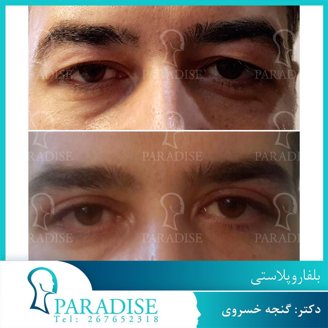 بلفاروپلاستی دکتر هومن گنجه خسروی