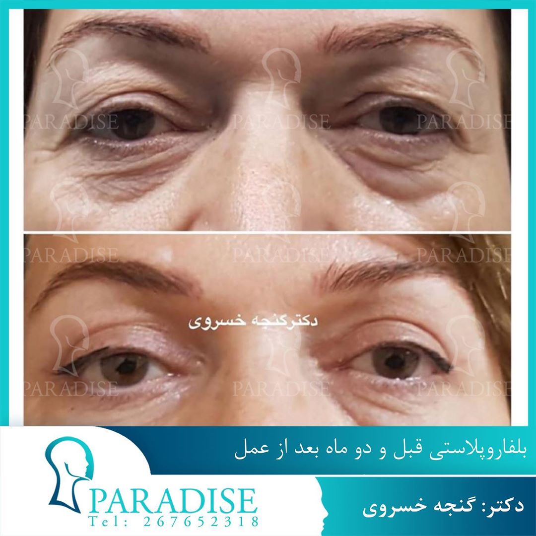 بلفاروپلاستی دکتر هومن گنجه خسروی