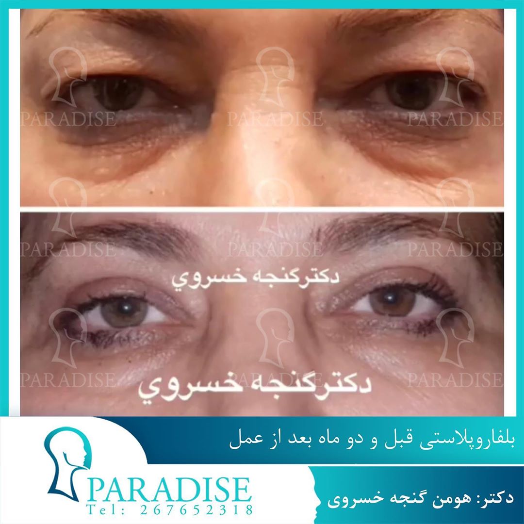 بلفاروپلاستی دکتر هومن گنجه خسروی