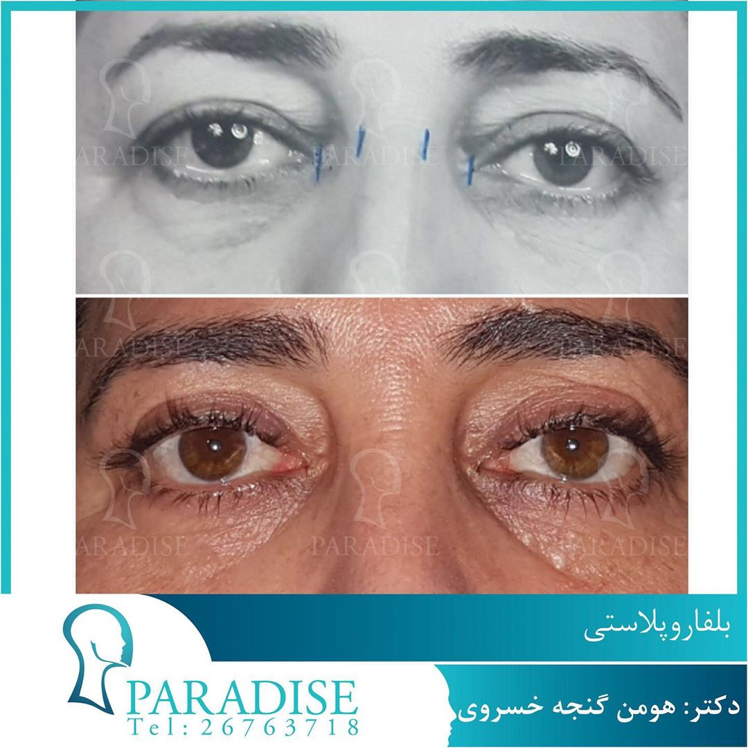 بلفاروپلاستی دکتر هومن گنجه خسروی