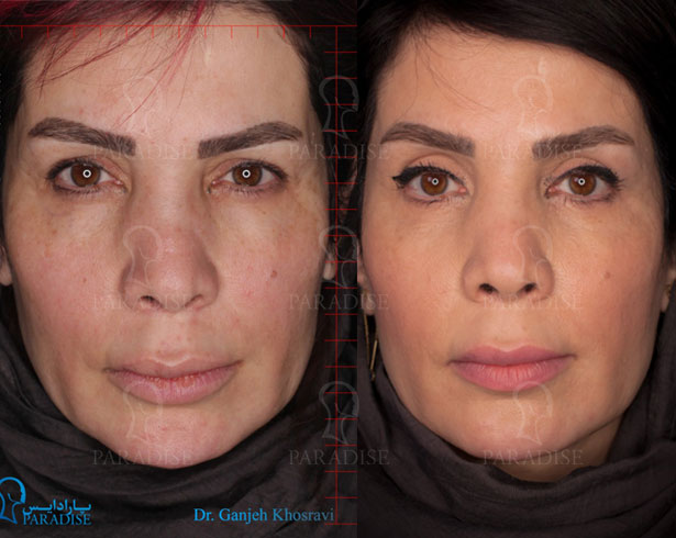 عکس از بلفارو پلاستی عمل زیبایی پلک