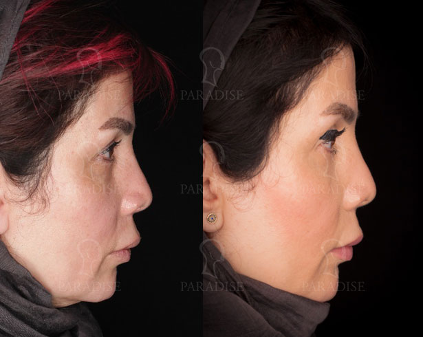 عکس از بلفارو پلاستی عمل زیبایی پلک