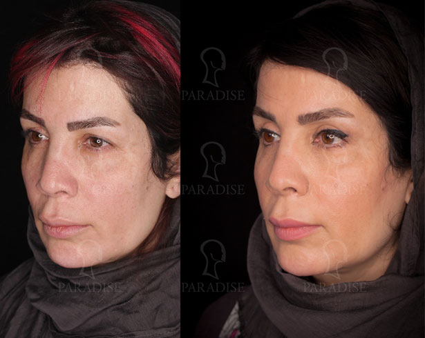 عکس از بلفارو پلاستی عمل زیبایی پلک