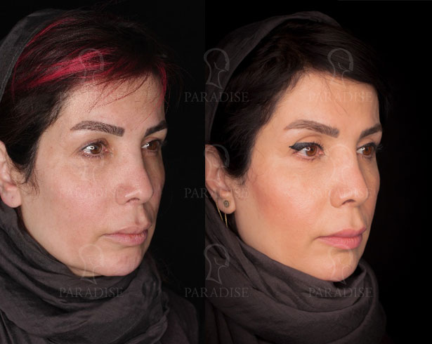 عکس از بلفارو پلاستی عمل زیبایی پلک