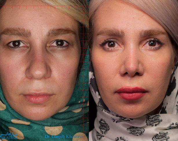 عکس از بلفارو پلاستی عمل زیبایی پلک