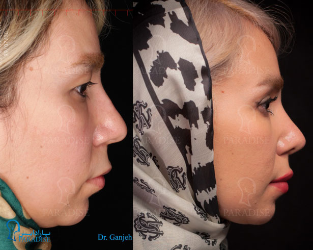 عکس از بلفارو پلاستی عمل زیبایی پلک