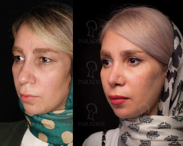 عکس از بلفارو پلاستی عمل زیبایی پلک