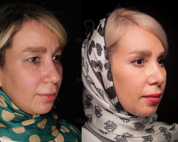 عکس از بلفارو پلاستی عمل زیبایی پلک