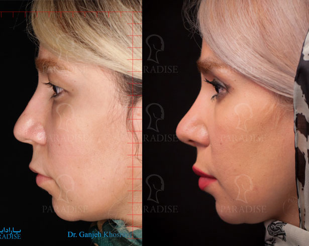 عکس از بلفارو پلاستی عمل زیبایی پلک