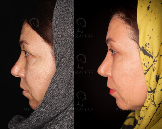 عکس از بلفارو پلاستی عمل زیبایی پلک