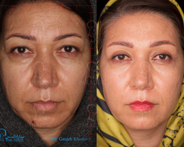 عکس از بلفارو پلاستی عمل زیبایی پلک