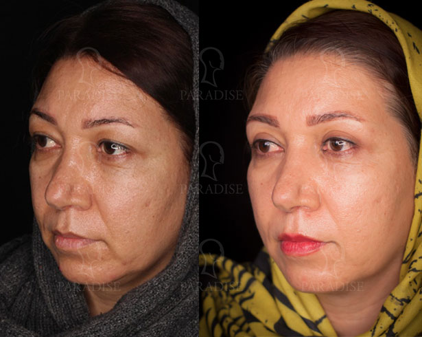 عکس از بلفارو پلاستی عمل زیبایی پلک