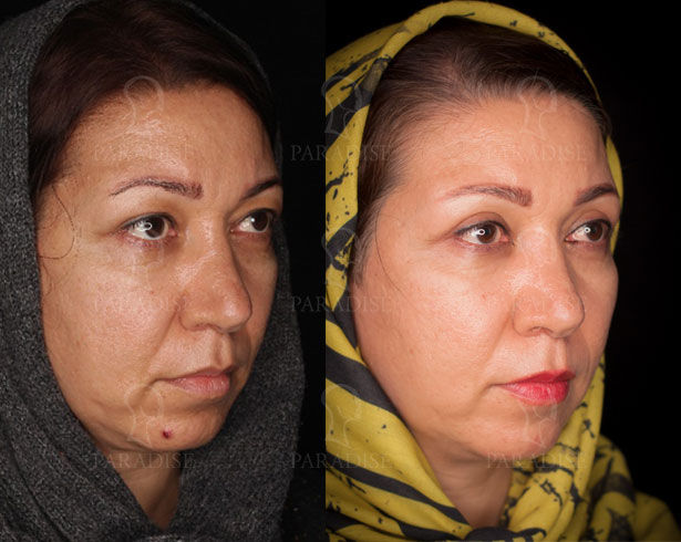 عکس از بلفارو پلاستی عمل زیبایی پلک