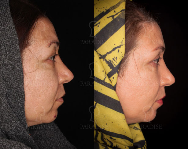 عکس از بلفارو پلاستی عمل زیبایی پلک