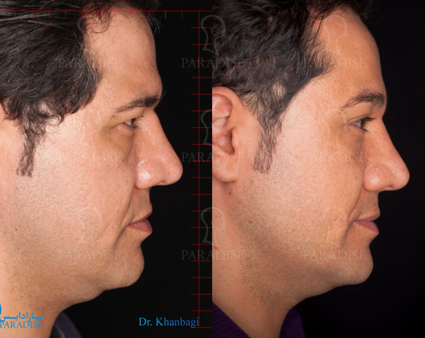 عکس از بلفارو پلاستی عمل زیبایی پلک