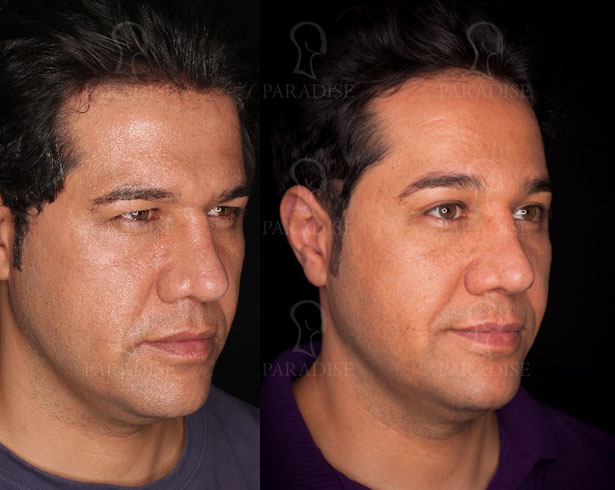 عکس از بلفارو پلاستی عمل زیبایی پلک