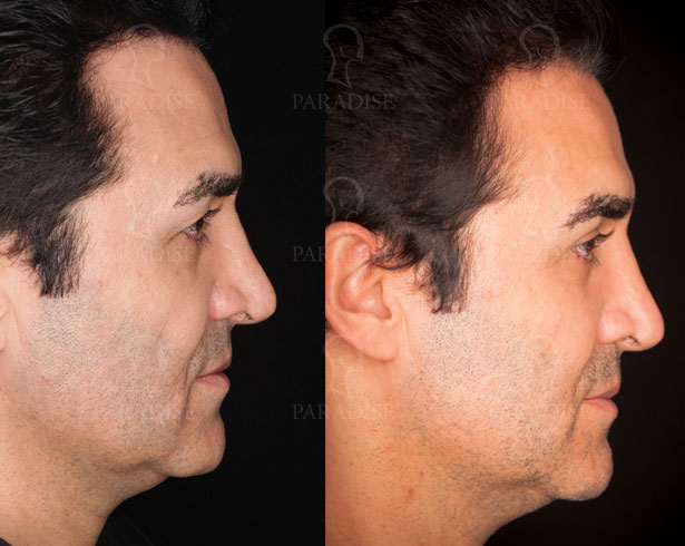 عکس از بلفارو پلاستی عمل زیبایی پلک