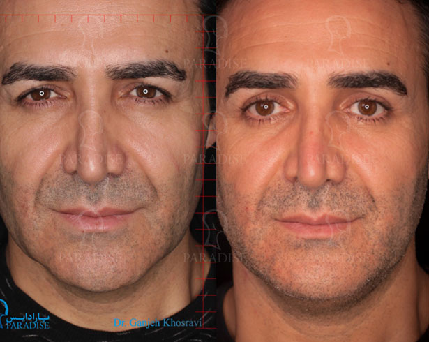 عکس از بلفارو پلاستی عمل زیبایی پلک