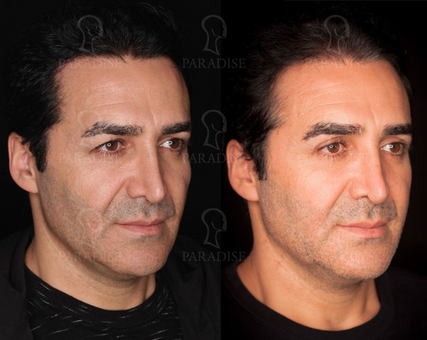 عکس از بلفارو پلاستی عمل زیبایی پلک