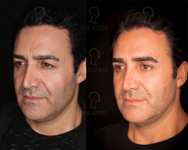 عکس از بلفارو پلاستی عمل زیبایی پلک