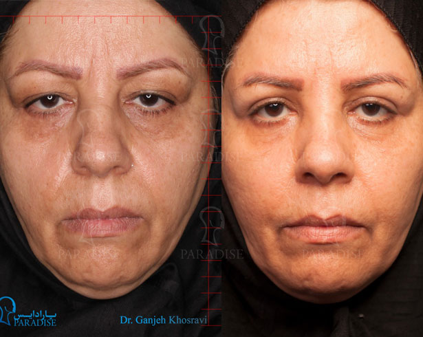 عکس از بلفارو پلاستی عمل زیبایی پلک