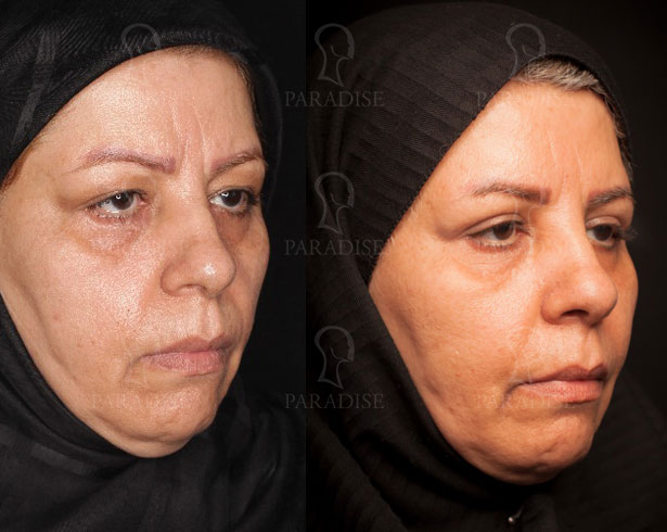 عکس از بلفارو پلاستی عمل زیبایی پلک