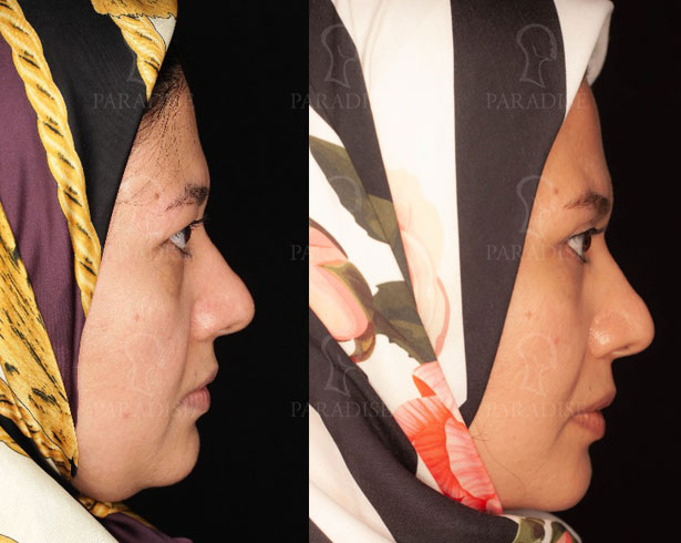 عکس از بلفارو پلاستی عمل زیبایی پلک