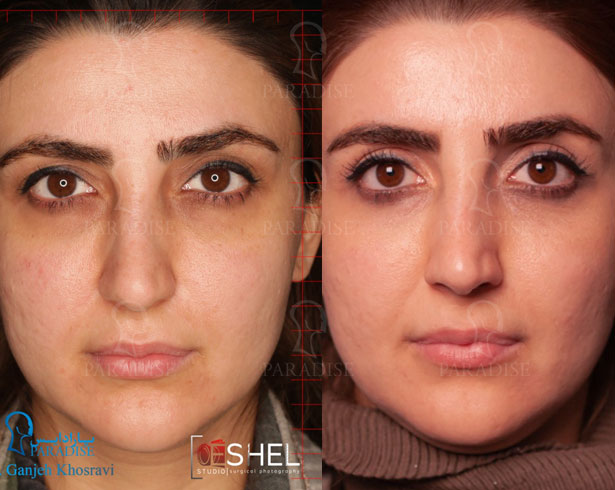 عکس از بلفارو پلاستی عمل زیبایی پلک