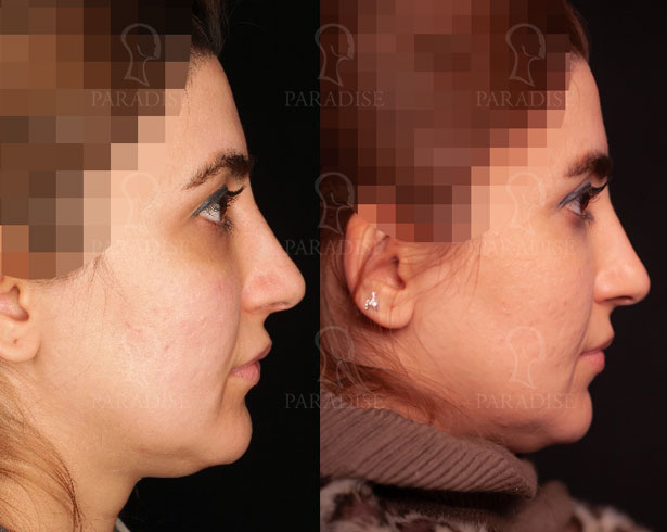 عکس از بلفارو پلاستی عمل زیبایی پلک