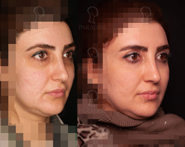 عکس از بلفارو پلاستی عمل زیبایی پلک