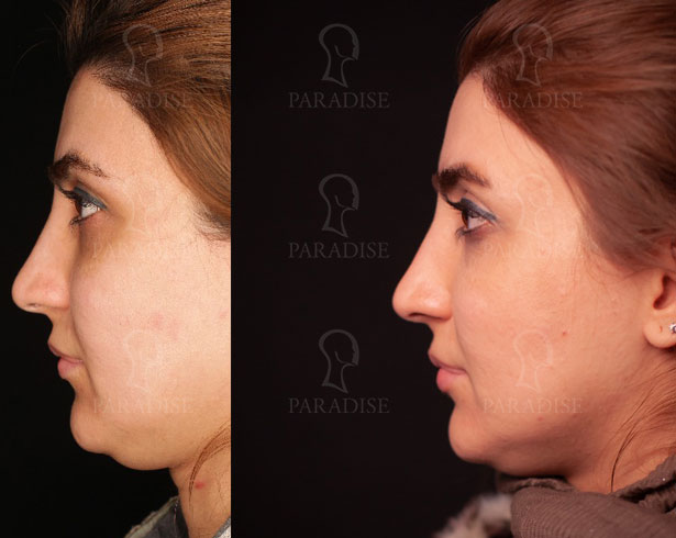 عکس از بلفارو پلاستی عمل زیبایی پلک