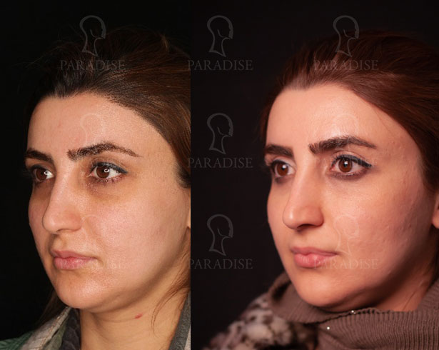 عکس از بلفارو پلاستی عمل زیبایی پلک