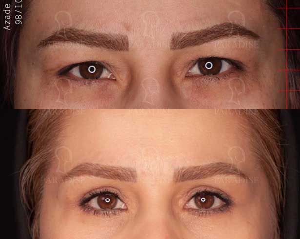 عکس بلفاروپلاستی دکتر هومن گنجه خسروی