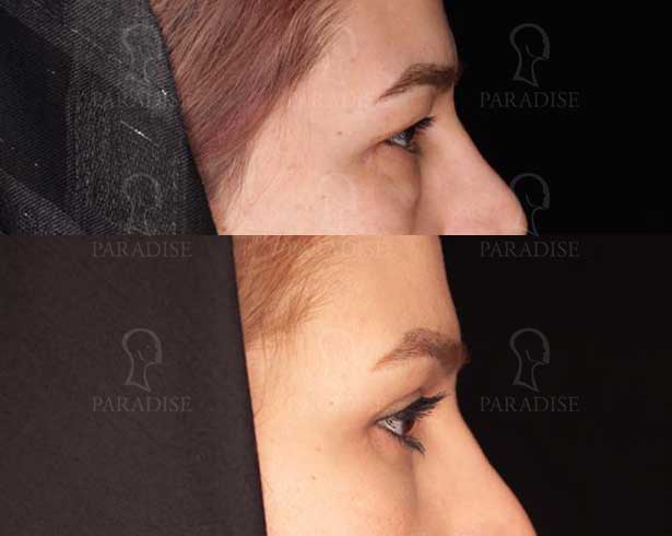 عکس بلفاروپلاستی دکتر هومن گنجه خسروی