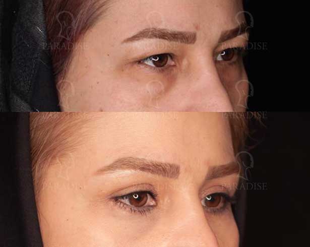 عکس بلفاروپلاستی دکتر هومن گنجه خسروی