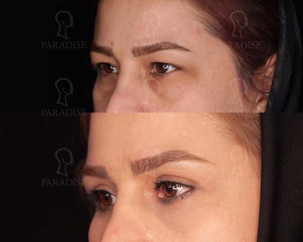 عکس بلفاروپلاستی دکتر هومن گنجه خسروی