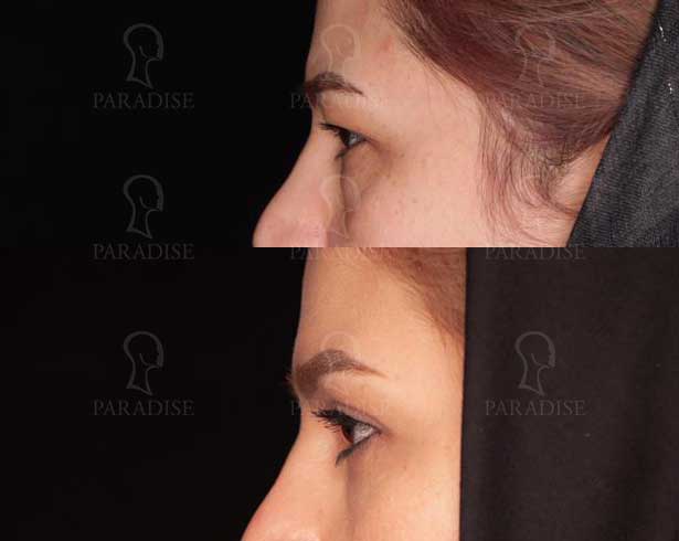 عکس بلفاروپلاستی دکتر هومن گنجه خسروی