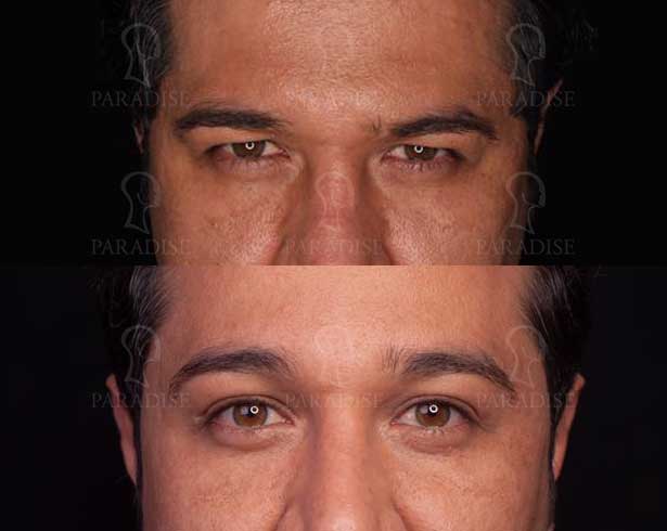 عکس بلفاروپلاستی دکتر هومن گنجه خسروی