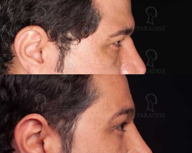 عکس بلفاروپلاستی دکتر هومن گنجه خسروی