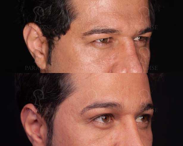 عکس بلفاروپلاستی دکتر هومن گنجه خسروی