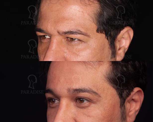 عکس بلفاروپلاستی دکتر هومن گنجه خسروی