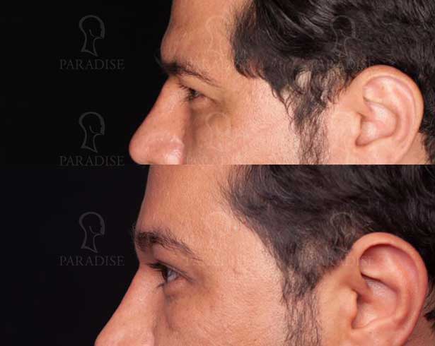 عکس بلفاروپلاستی دکتر هومن گنجه خسروی