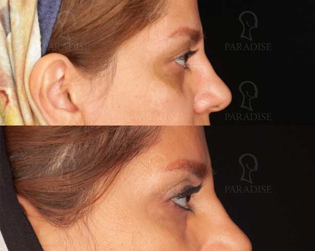 عکس بلفاروپلاستی دکتر هومن گنجه خسروی