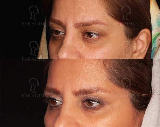 عکس بلفاروپلاستی دکتر هومن گنجه خسروی