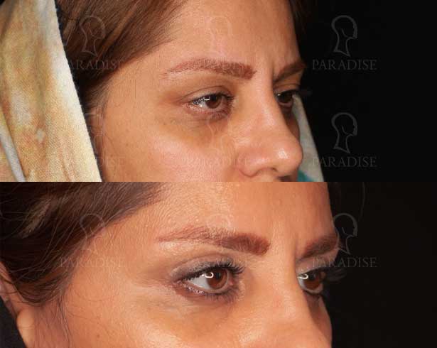 عکس بلفاروپلاستی دکتر هومن گنجه خسروی