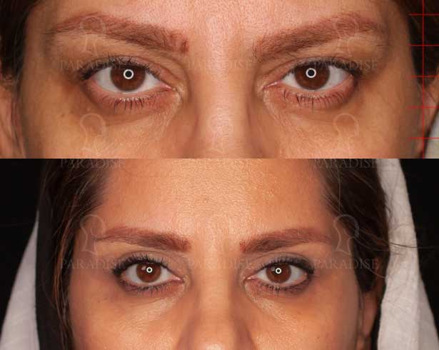 عکس بلفاروپلاستی دکتر هومن گنجه خسروی