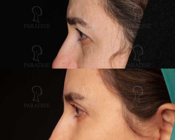 عکس بلفاروپلاستی دکتر هومن گنجه خسروی