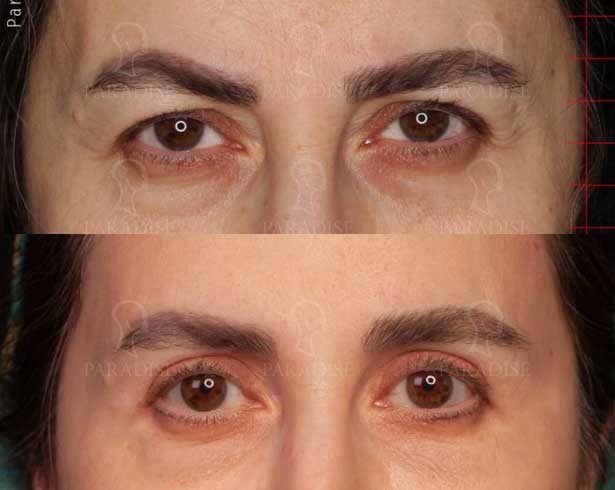 عکس بلفاروپلاستی دکتر هومن گنجه خسروی